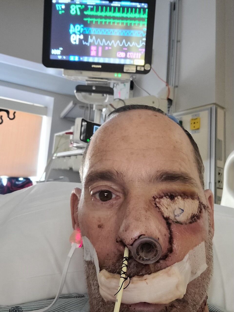 Cancer survivor wakes up from surgery without his right eye and confused by multiple scars